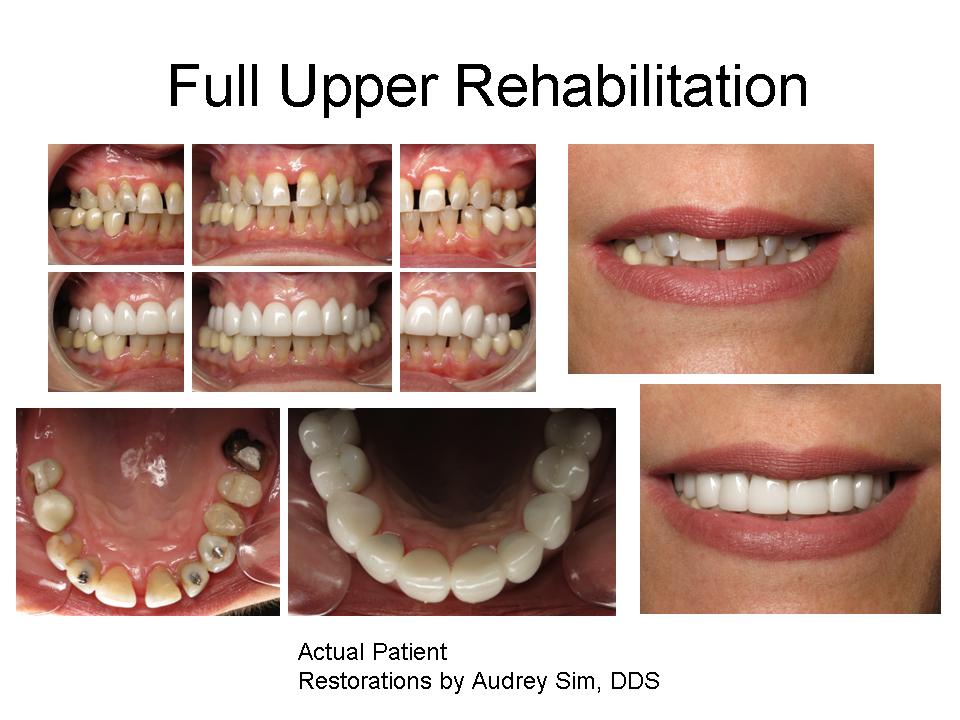 Full upper rehabilitation