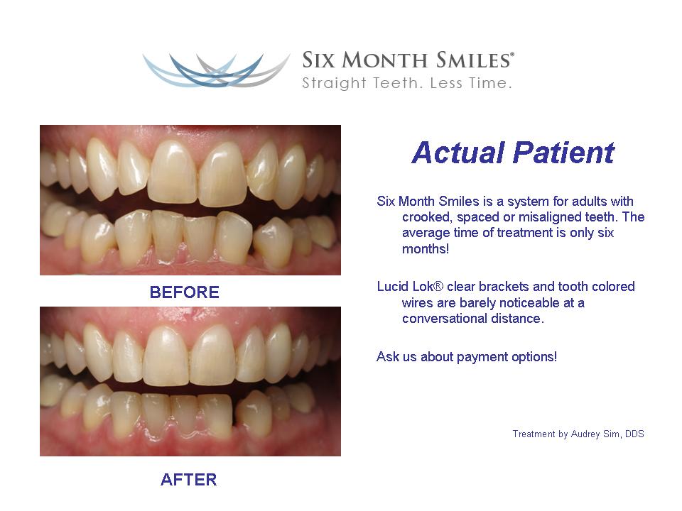 six month smiles straight teeth less time before and after