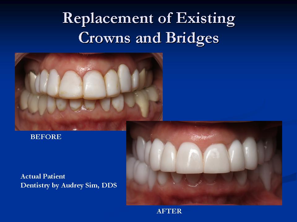 Replacement-of-Existing-Crowns-and-Bridges