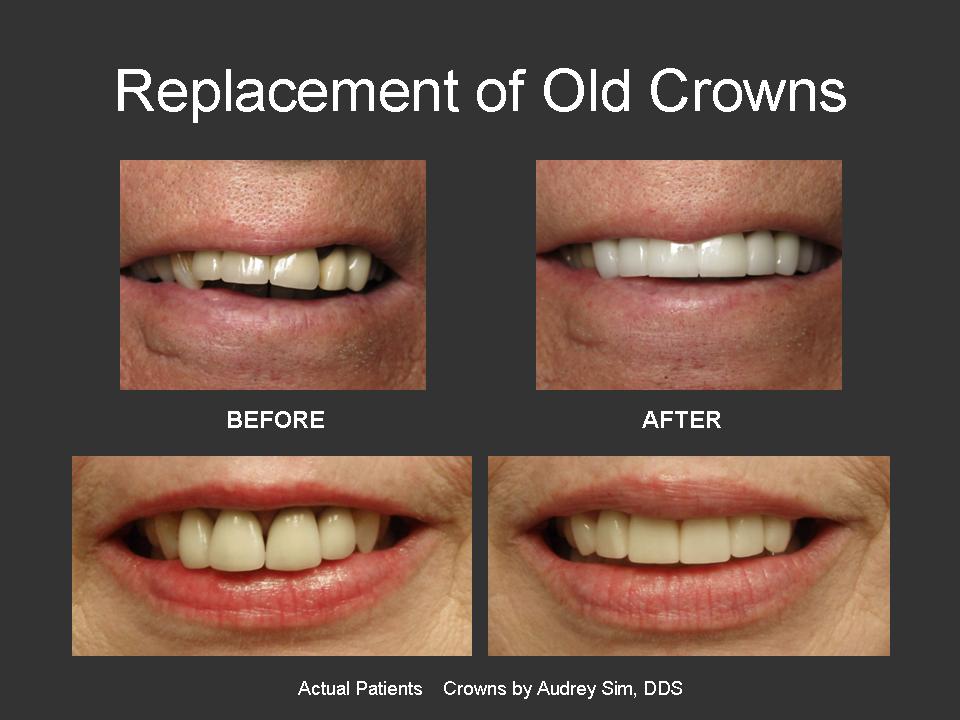 Replacement-of-Old-Crowns