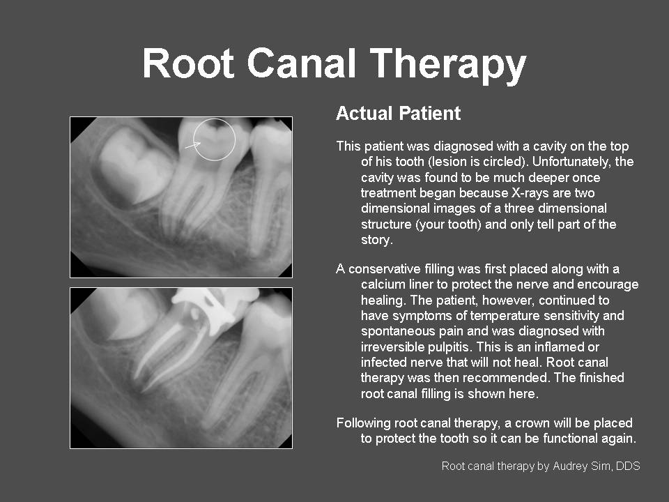 root canal therapy x-rays