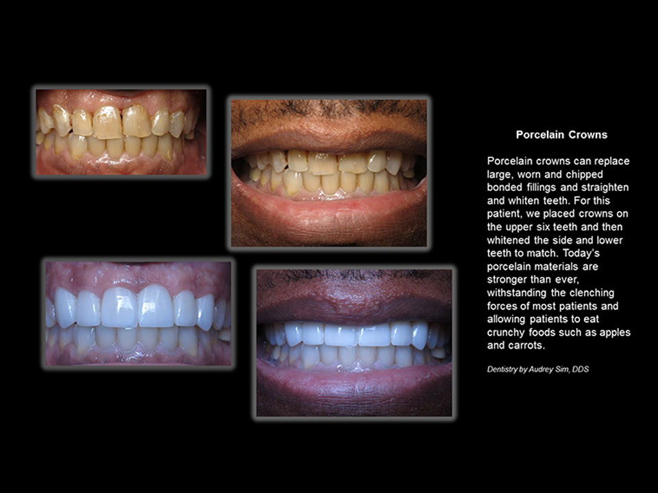 gallery-porcelain-crowns